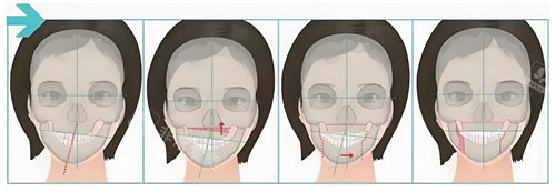 正頜手術(shù)手術(shù)步驟展示動畫圖