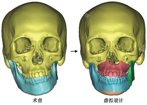 臉部歪斜術(shù)前術(shù)后動畫圖