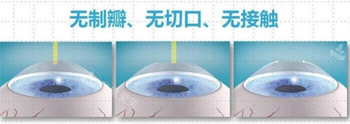 飞秒近视手术