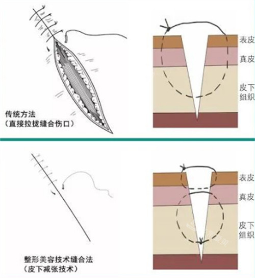 超减张精细缝合和传统缝合的区别图解