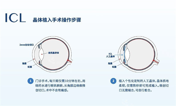 icl晶体植入解刨图