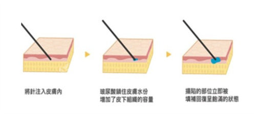 扒一扒:韩国德俊皮肤科注射玻尿酸技术怎么样?医生施术正规吗?