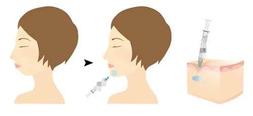 玻尿酸豐下巴的步驟