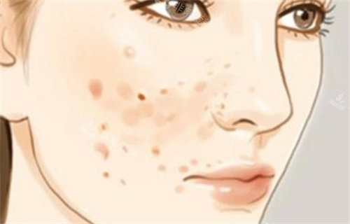 大面积长痘烂脸，我在韩国皮肤科看痘痘的经历，原来去痘痘真的这么简单！