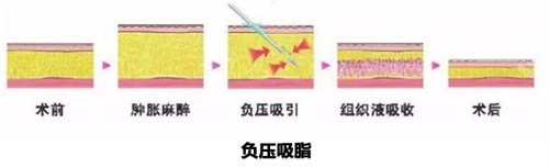 抽脂手術(shù)方式動畫圖