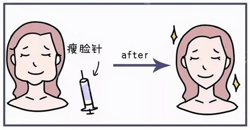 注射瘦臉針前后對比動畫圖