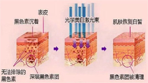 光子嫩肤原理