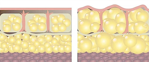 自體脂肪填充前后皮膚層動畫圖