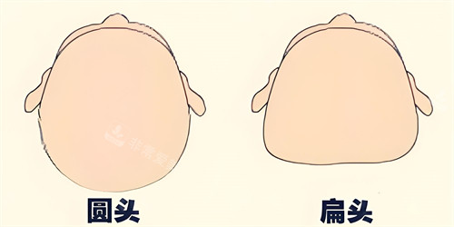 頭部填充術(shù)前手術(shù)上方對比動畫圖