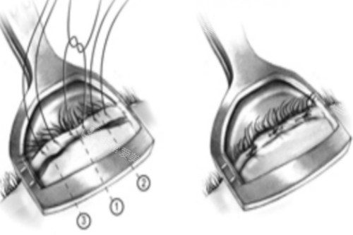倒睫手术图