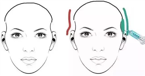 太陽穴凹陷玻尿酸注射對比動畫圖