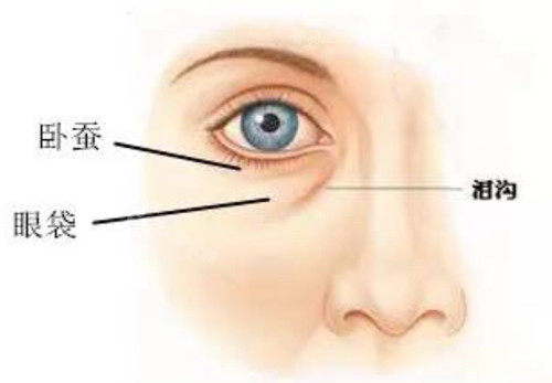 眼下卧蚕泪沟及眼袋对比示意图