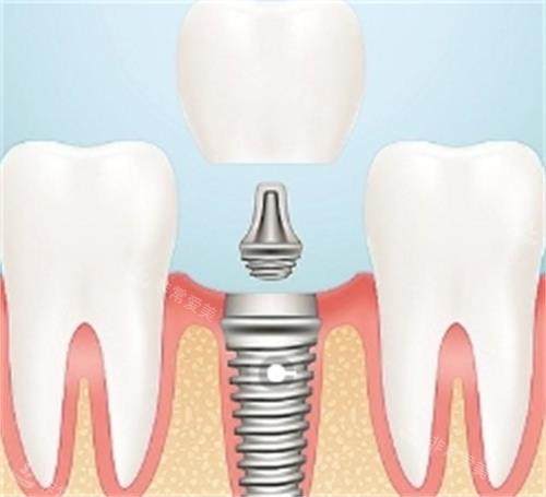 种植牙的组成部分