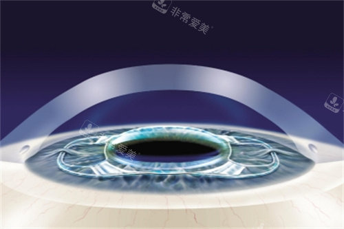 ICL晶体4