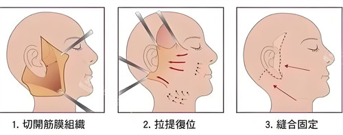 面部除皺拉皮法演示動畫圖