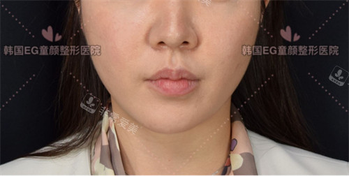 韓國EG童顏皮膚眼科超聲提升術(shù)后圖 韓國EG童顏皮膚眼科超聲提升術(shù)后圖