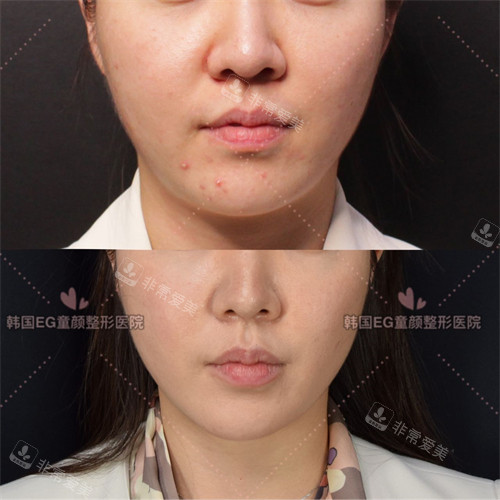 韓國EG童顏皮膚眼科超聲提升前后對比 韓國EG童顏皮膚眼科超聲提升前后對比