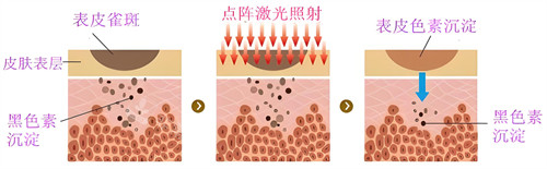 激光去除黑色素原理動(dòng)畫圖 激光去除黑色素原理動(dòng)畫圖