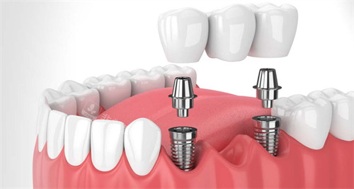 在口腔內(nèi)進(jìn)行種植牙