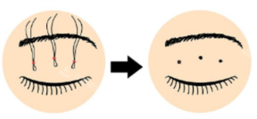 皮下速接双眼皮操作过程图解