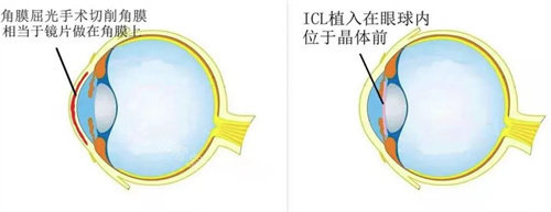 韩国近视手术技术怎么样?看我的韩国近视手术日记！ICL晶体真香~