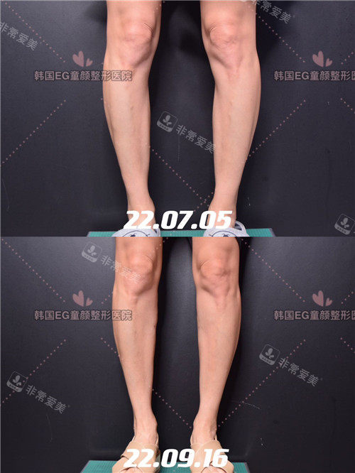 小腿玻尿酸填充 小腿玻尿酸填充