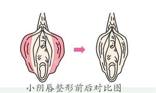小陰唇整形前后對(duì)比圖