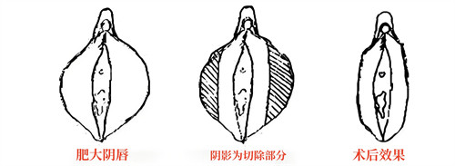小陰唇肥大直接切除法演示動(dòng)畫(huà)圖