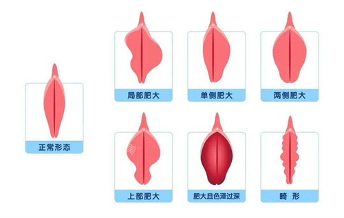 正常陰唇形態(tài)和陰唇肥大對(duì)比動(dòng)畫(huà)圖