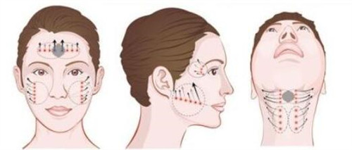 面部拉皮手术怎么做？来看手术详细指南！
