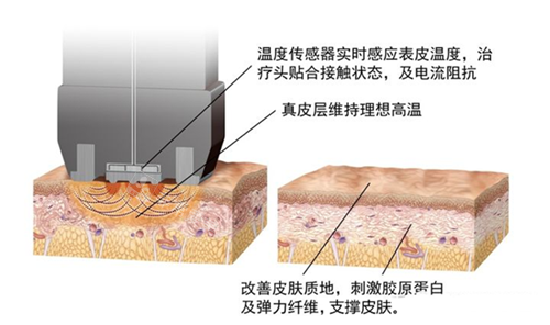 鉆石超塑的作用