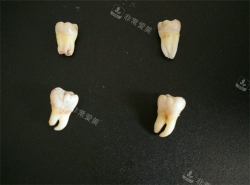 不同类型智齿实物展示图