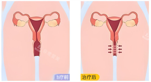 生物束带紧缩术原理动画演示图