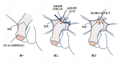 陰莖增長(zhǎng)手術(shù)詳細(xì)步驟演示動(dòng)畫(huà)圖