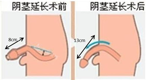 阴茎增长手术前后对比动画图