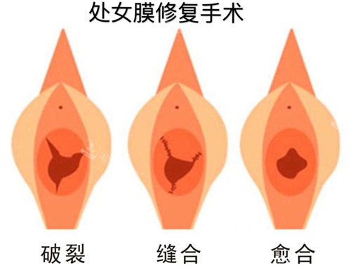 處女膜修復手術過程動畫演示圖