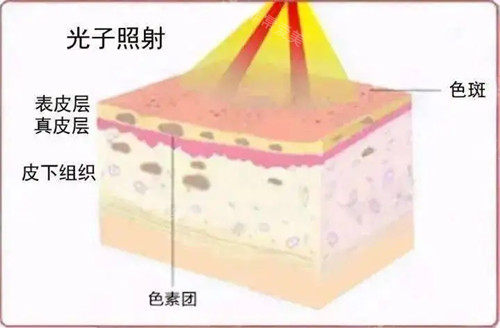 光子嫩肤原理卡通示意图