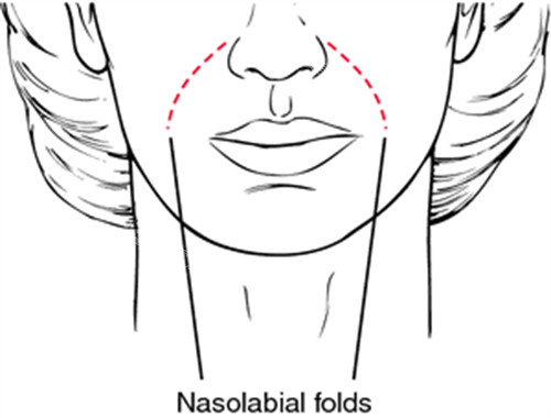 鼻基底凹陷会出现法令纹
