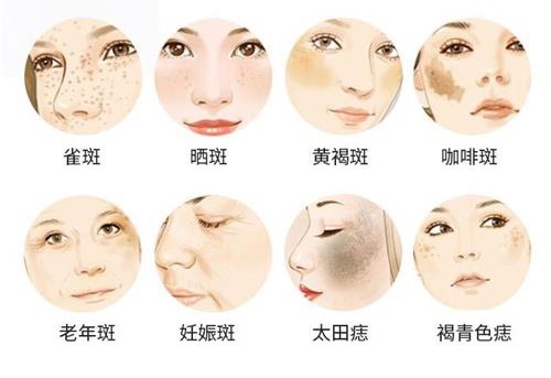 韩国皮秒仪器祛斑是什么原理?我去做了三次脸上晒斑真的淡了好多!