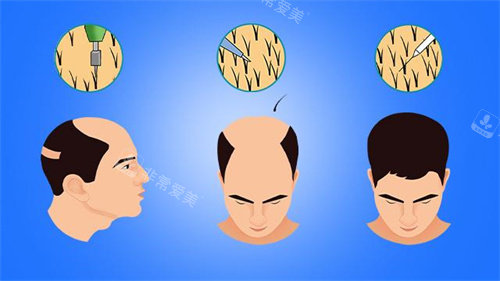 毛发移植手术怎么做？植发流程是什么？