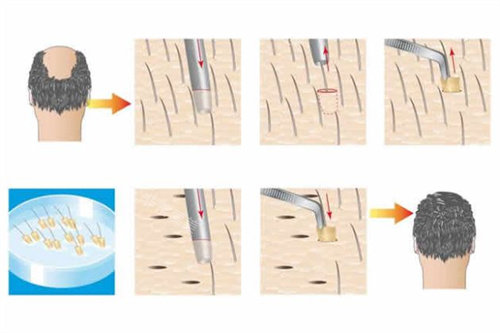 毛囊移植步骤动画演示图
