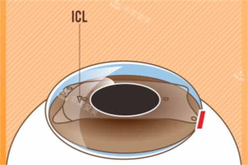 ICL晶体植入后示意图