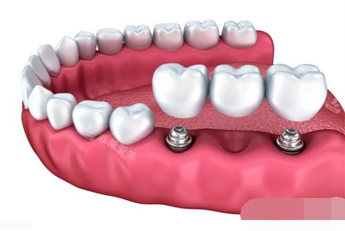 两颗种植牙安装联排牙冠漫画示意图