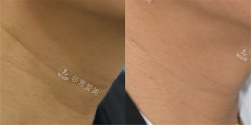 韓國昌皮膚科注射玻尿酸去頸紋前后對(duì)比圖 韓國昌皮膚科注射玻尿酸去頸紋前后對(duì)比圖