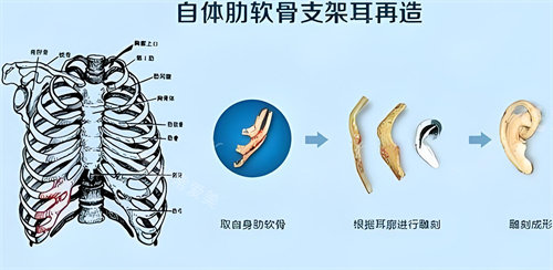 肋软骨直埋耳再造术步骤演示图