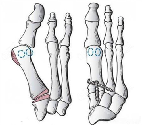 拇外翻微創(chuàng)手術(shù)動(dòng)畫演示圖