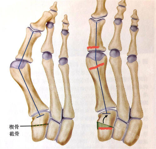 拇外翻傳統(tǒng)手術(shù)動(dòng)畫展示圖