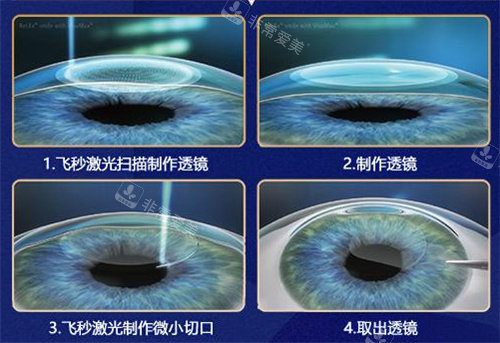 全飞秒手术