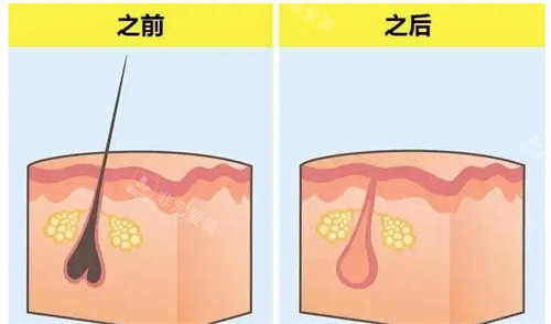 脱毛前后的毛囊