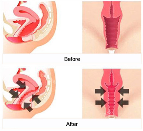 阴道紧缩术前后对比
